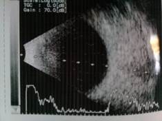 Hipertrofia congénita del epitelio pigmentario de la retina un