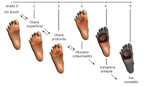 Procedimientos Quirúrgicos Del Pie Diabético Neuropático