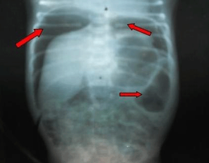 Fig. 1. Rayo x: abdomen simple vista anteroposterior de pié. Aire libre en cavidad abdominal