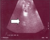 Fig. 1. Ultrasonido abdominal donde se apreció líquido denso libre en fosa ilíaca derecha 