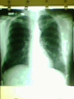 Fig. 2. Tórax sin lesiones pleuropulmonares
