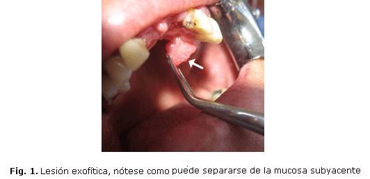 Fig. 1. Lesión exofítica, nótese como puede separarse de la mucosa subyacente