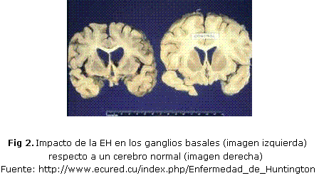 Figura 2. Impacto de la EH en los ganglios basales (imagen izquierda) respecto a un cerebro normal (imagen derecha)