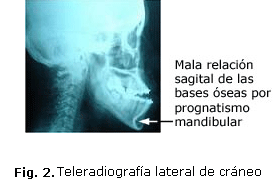 Fig. 2. Teleradiografía lateral de cráneo