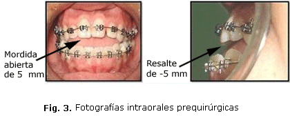 Fig. 3. Fotografías intraorales prequirúrgicas