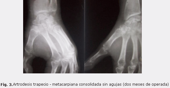 Fig. 3. Artrodesis trapecio - metacarpiana consolidada sin agujas (dos meses de operada)