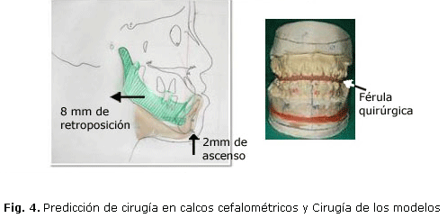 Fig. 4. Predicción de cirugía en calcos cefalométricos y Cirugía de los modelos.