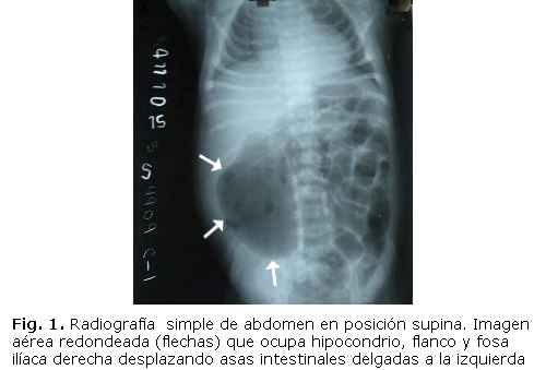 Fig. 1. Radiografía simple de abdomen en posición supina. Imagen aérea redondeada (flechas) que ocupa hipocondrio, flanco y fosa ilíaca derecha desplazando asas intestinales delgadas a la izquierda