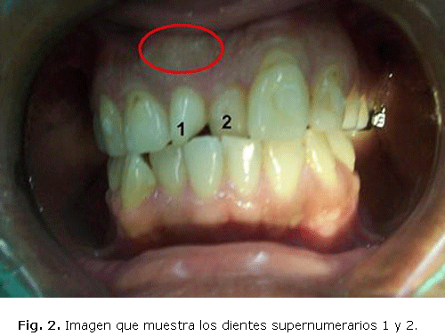 Fig. 2. Imagen que muestra los dientes supernumerarios 1 y 2. 