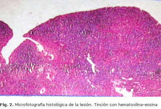 Fig. 2. Microfotografía histológica de la lesión. Tinción con hematoxilina-eosina