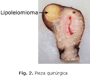 Fig. 2. Pieza quirúrgica