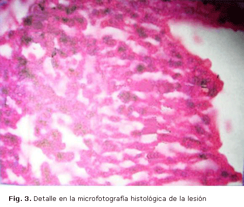 Fig. 3. Detalle en la microfotografía histológica de la lesión 