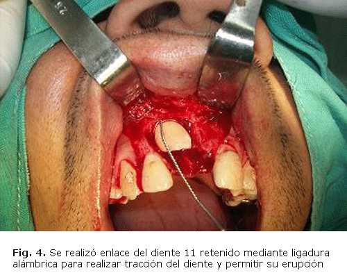 Fig. 4 Se realizó enlace del diente 11 retenido mediante ligadura alámbrica para realizar tracción del diente y permitir su erupción