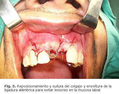 Fig. 5. Reposicionamiento y sutura del colgajo y envoltura de la ligadura alámbrica para evitar lesiones en la mucosa labial