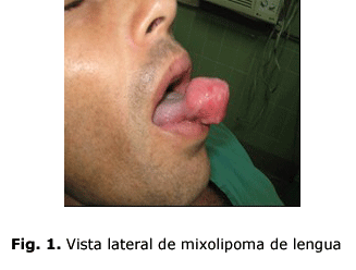 Fig. 1. Vista lateral de mixolipoma de lengua