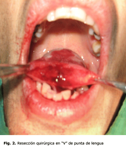 Fig. 2. Resección quirúrgica en “V” de punta de lengua