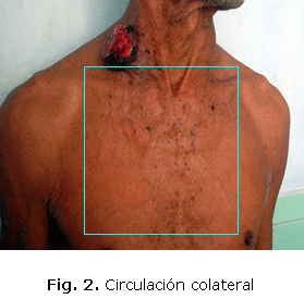 Fig.2. TAC de cráneo con lesión de partes blandas y erosión focal