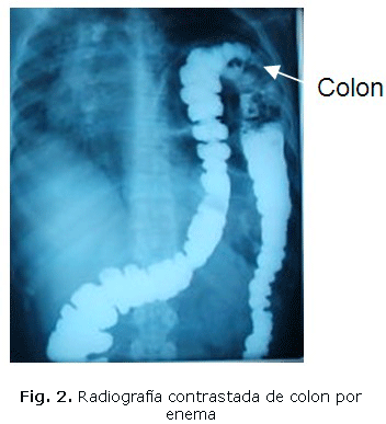Fig. 2. Radiografía contrastada de colon por enema 