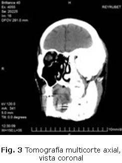 Fig. 3 Tomografía multicorte axial, vista coronal