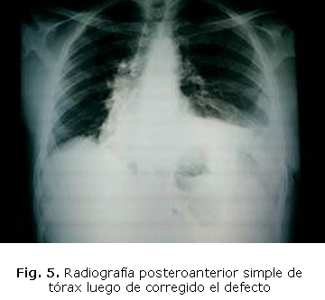 Fig. 5. Radiografía posteroanterior simple de tórax luego de corregido el defecto 