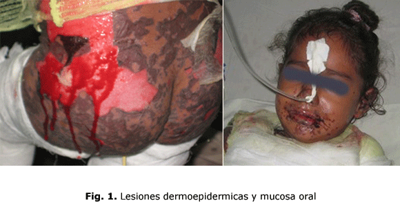 Fig. 1. Lesiones dermoepidermicas y mucosa oral