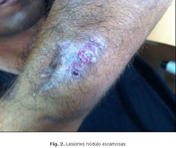 Fig. 2. Lesiones nódulo escamosas