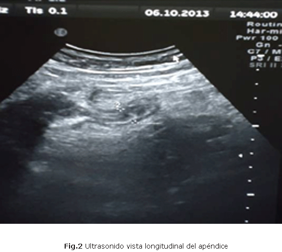 Fig.2 Ultrasonido vista longitudinal del apéndice