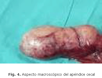 Fig. 4. Aspecto macroscópico del apéndice cecal