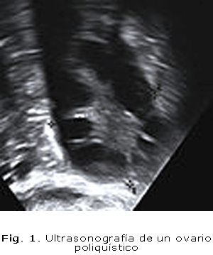 Fig. 1. Ultrasonografía de un ovario poliquístico