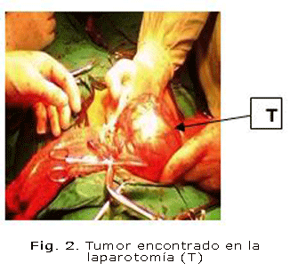 Fig. 2. Tumor encontrado en la laparotomía (T)