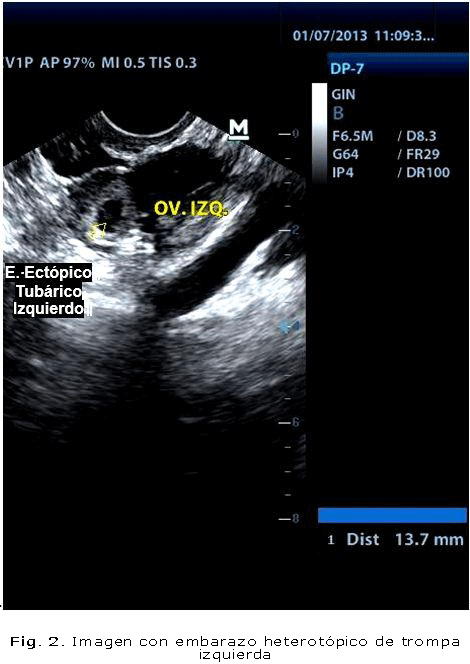 Fig. 2. Imagen con embarazo heterotópico de trompa izquierda