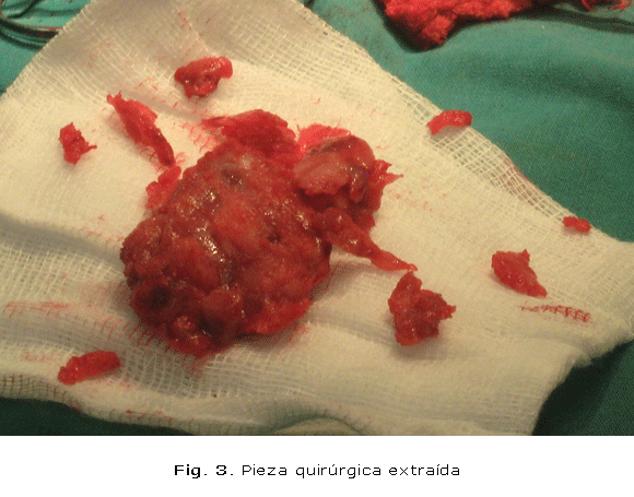 Fig. 3. Pieza quirúrgica extraída