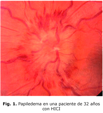 Fig. 1. Papiledema en una paciente de 32 años con HICI