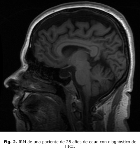 Fig. 2. IRM de una paciente de 28 años de edad con diagnóstico de HICI.