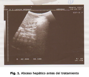 Fig. 1. Abceso hepático antes del tratamiento