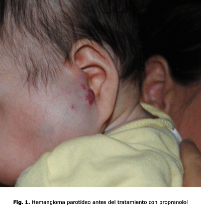 Fig. 1.Hemangioma parotídeo antes del tratamiento con propranolol