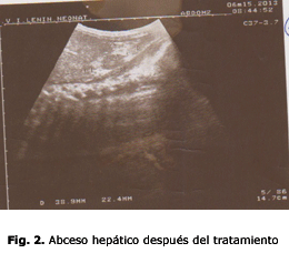 Fig. 2. Abceso hepático después del tratamiento