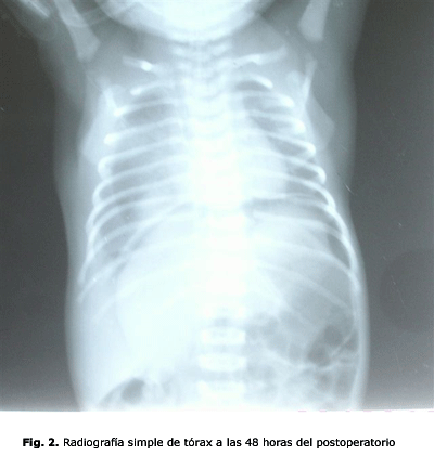 Fig. 2. Radiografía simple de tórax a las 48 horas del postoperatorio 