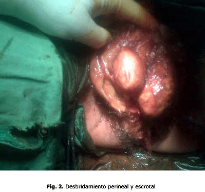 Fig. 2. Desbridamiento perineal y escrotal