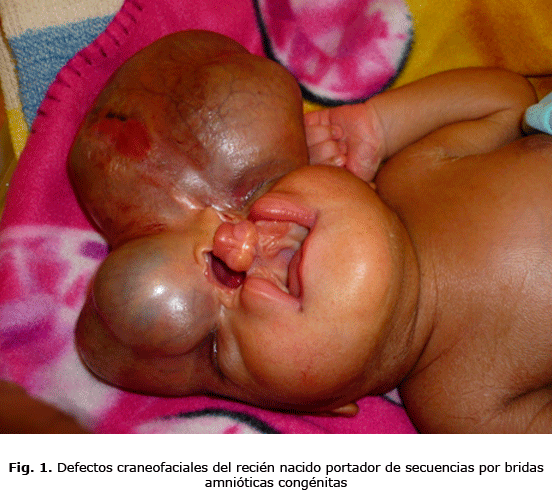 Fig. 1. Defectos craneofaciales del recién nacido portador de secuencias por bridas