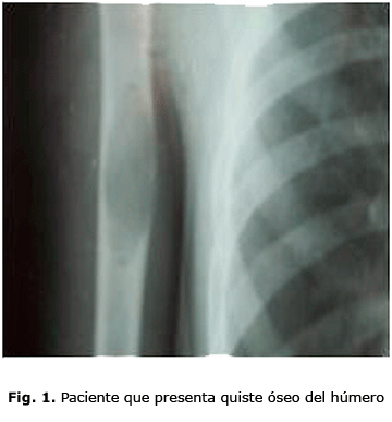 Fig. 1. Paciente que presenta quiste óseo del húmero
