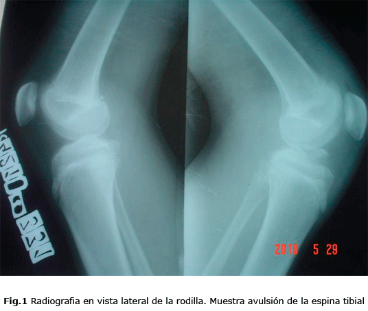 Fig.1 Radiografia en vista lateral de la rodilla. Muestra avulsión de la espina tibial