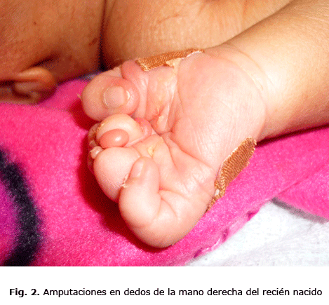 Fig. 2. Amputaciones en dedos de la mano derecha del recién nacido