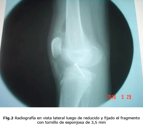 Fig.2 Radiografía en vista lateral luego de reducido y fijado el