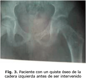 Fig. 3. Paciente con un quiste óseo de la 