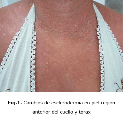Fig.1. Cambios de esclerodermia en piel región anterior del cuello y tórax