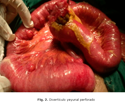 Fig. 2. Divertículo yeyunal perforado