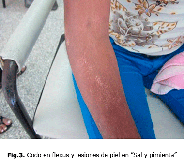 Fig.3. Codo en flexus y lesiones de piel en ”Sal y pimienta”