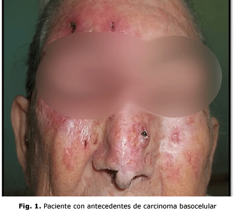 Fig. 1. Paciente con antecedentes de carcinoma basocelular