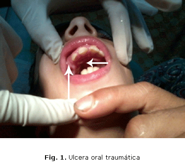 Fig. 1. Ulcera oral traumática